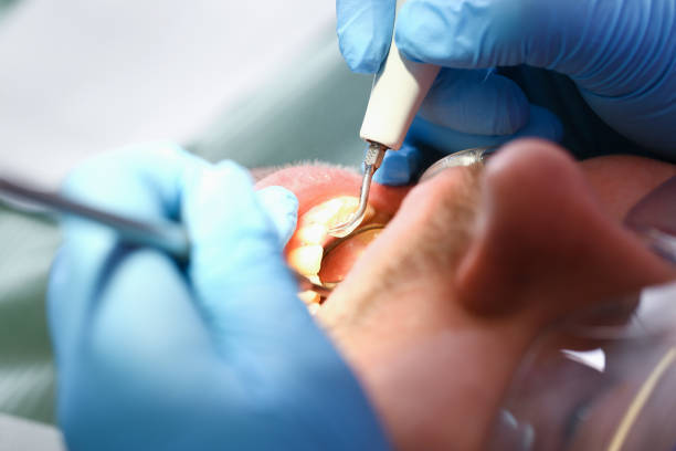 Best Emergency Dentist for Lost Fillings or Crowns in Versailles, PA